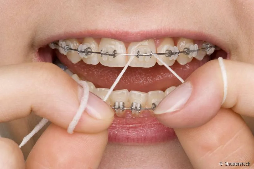Uso de fio dental em dentes com aparelho ortodôntico.