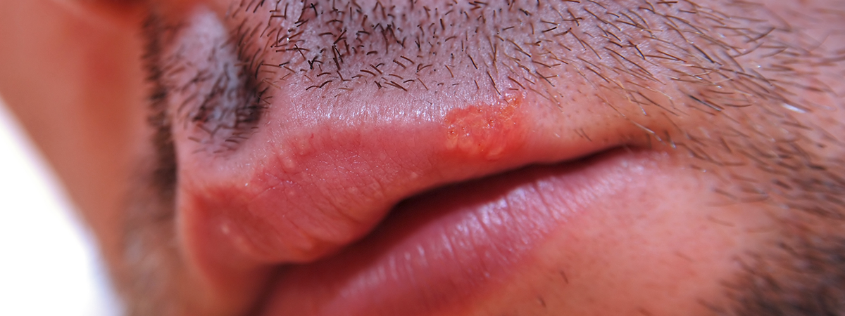 Close-up de lábios masculinos com sinais visíveis de herpes labial