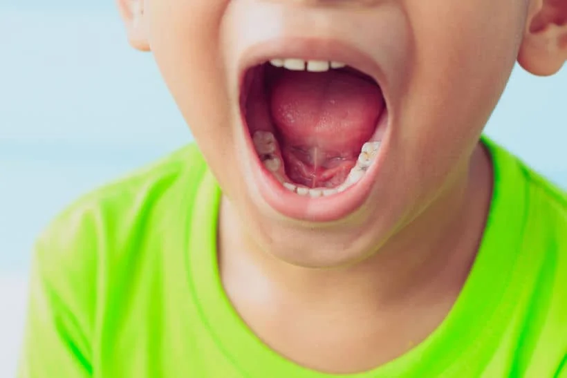 Mancha preta no dente pode significar uma cárie ou então o efeito de algum trauma ou medicamento
