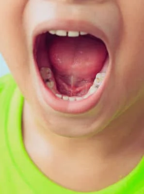 Mancha preta no dente só pode ser cárie? Dentista esclarece
