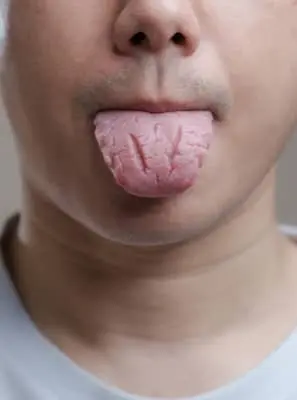 O que causa língua fissurada e quais cuidados tomar?