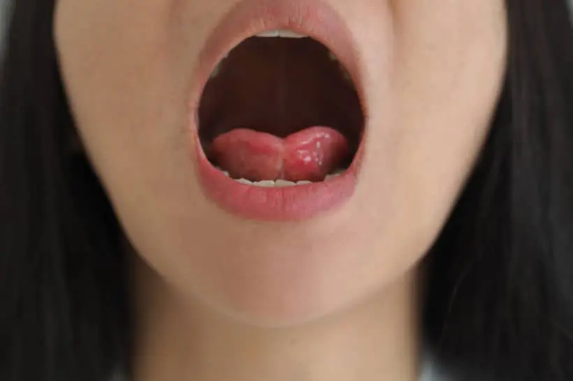A dor no freio da língua pode estar associada a disfunções anatômicas e infecções 