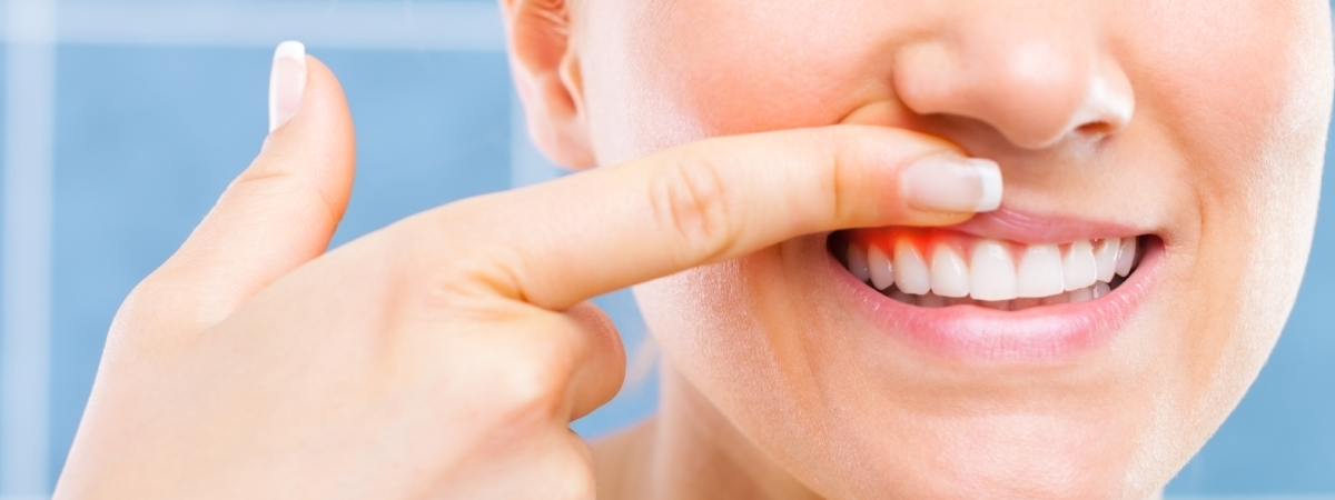 Pessoa sorrindo levanta o lábio superior com o dedo, mostrando gengiva vermelha e inflamada ao redor dos dentes brancos. 