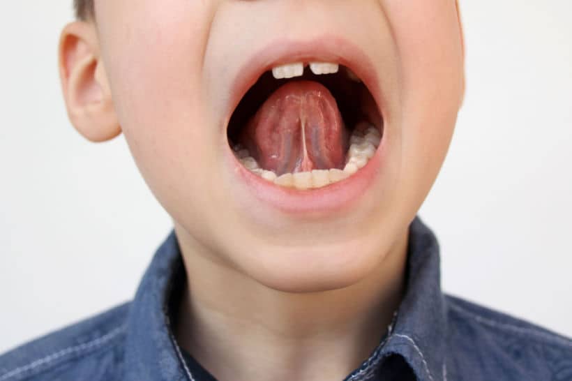 O freio labial é um tecido fino responsável por limitar o movimento da língua, auxiliando na fala, mastigação, deglutição, fonação e até respiração