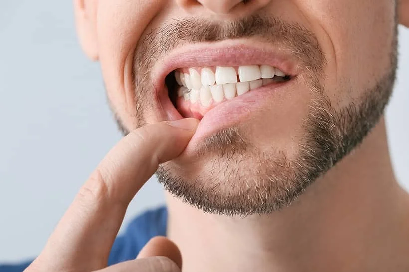 A espinha na gengiva nada mais é do que uma fístula dental - uma bolinha de pus causada por uma infecção no dente