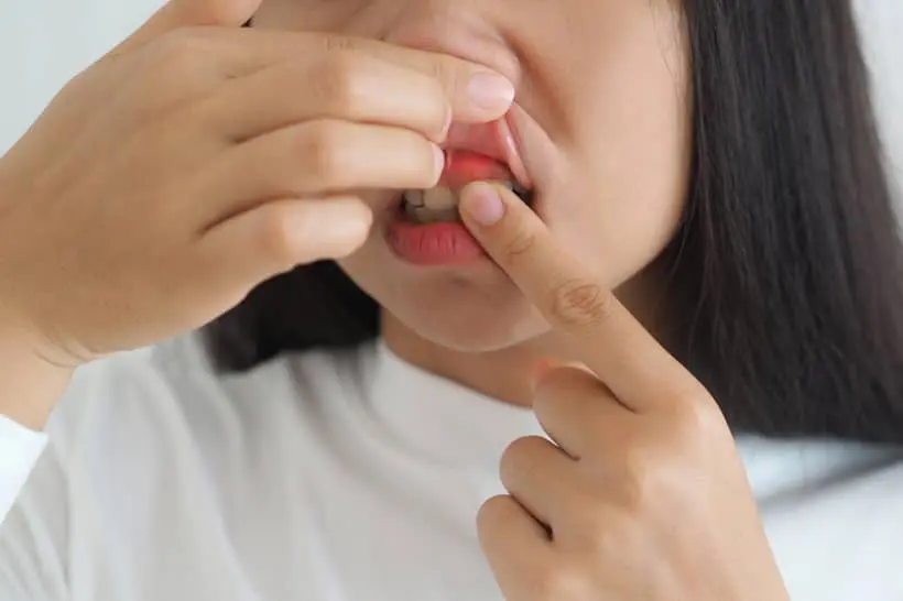 O machucado na gengiva pode ser um sinal de fístula dental, uma bolinha que surge devido a uma infecção bacteriana (lesão cariosa) no dente