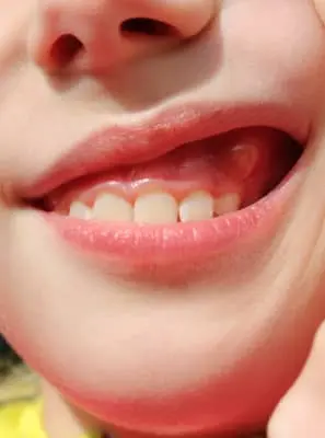 Fístula dental e bolha na gengiva são a mesma coisa?