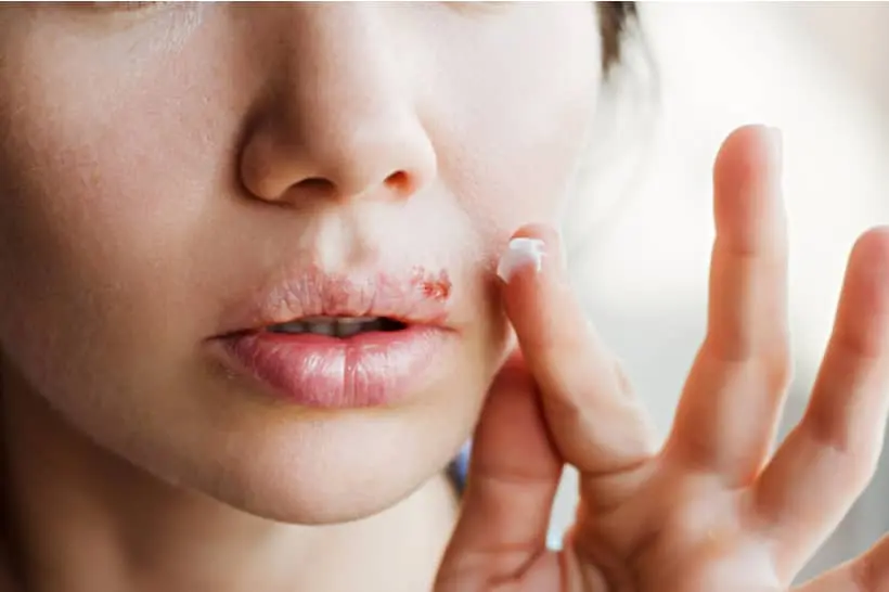O tratamento da herpes bucal pode ser feito com medicamentos orais ou de uso tópico