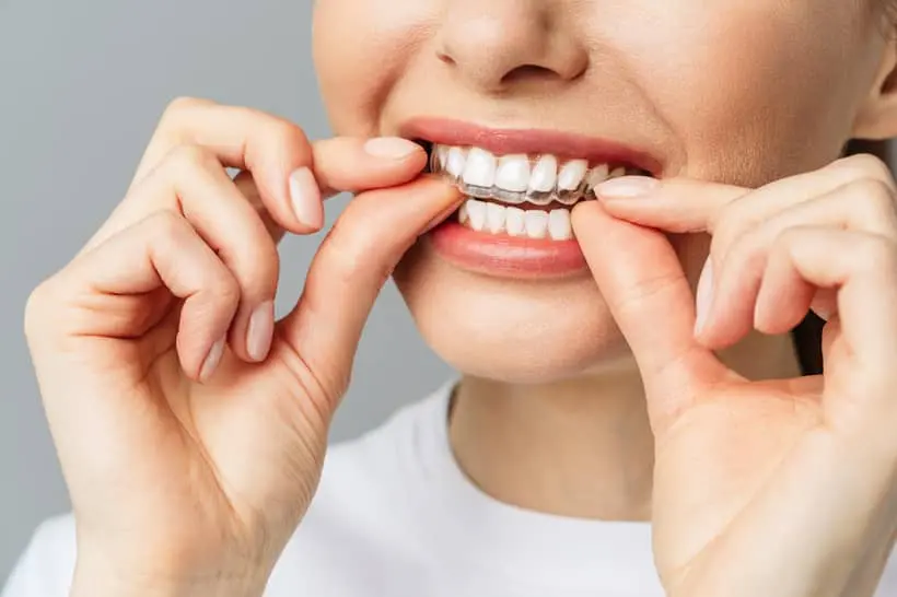 O gel clareador dental deve ser usado apenas pelo tempo indicado pelo dentista, o que garante um tratamento efetivo, sem causar danos à saúde bucal