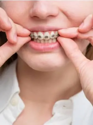 Aparelho ortodôntico deixa o dente mole?
