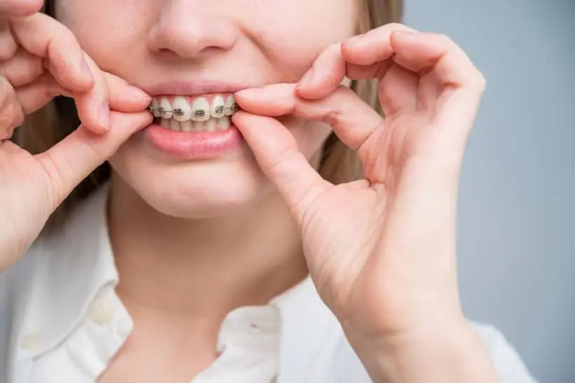 Aparelho ortodôntico atua corrigindo a posição dos dentes - o que, consequentemente, causa mobilidade e sensação de amolecimento