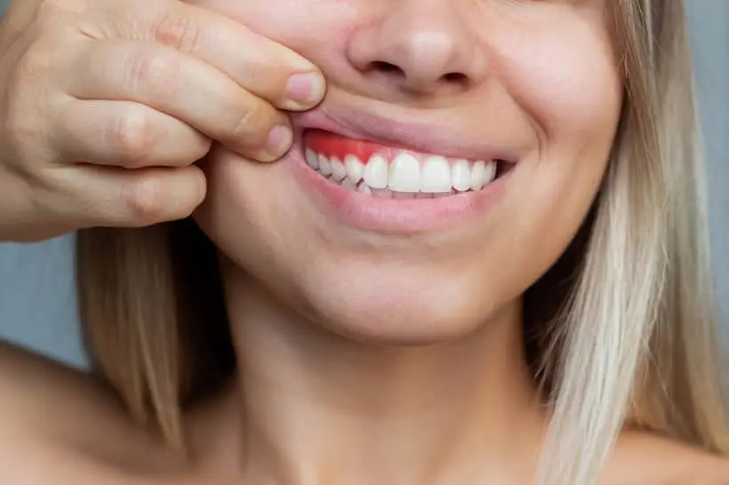 Gengivite é um tipo de doença gengival bastante comum, geralmente causada pela má higienização bucal