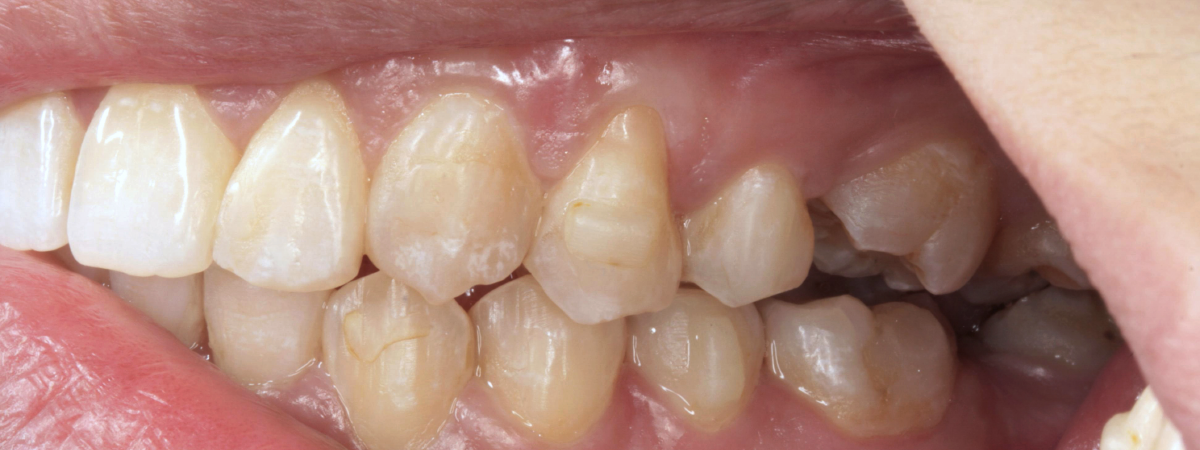 Vista interna de uma boca aberta mostrando dentes com algumas manchas e uma gengiva branca