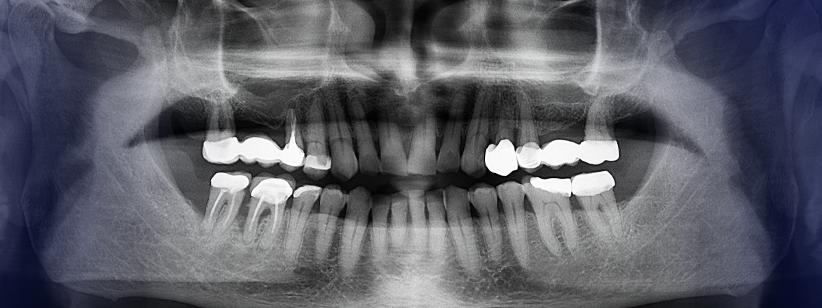 Radiografia panorâmica dental mostrando dentes superiores e inferiores 