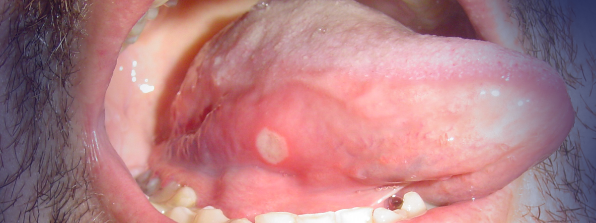 Close-up de uma boca aberta mostrando dentes, língua com afta e barba por fazer.