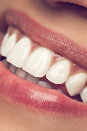 Descubra o impacto da periodontite na estética do sorriso