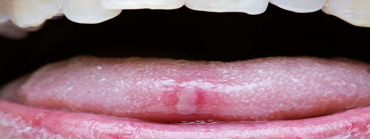  Close-up de uma boca entreaberta, mostrando a língua levemente texturizada e os lábios rosados, com detalhe de um pequeno corte no centro da língua.