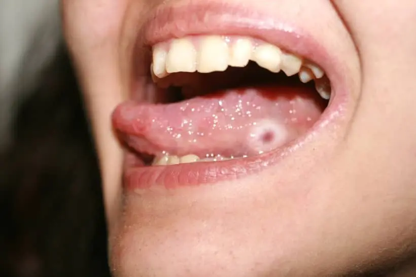 A higiene bucal evita que apareçam feridas na boca que pode ser porta de entrada para o vírus da Varíola de Macaco
