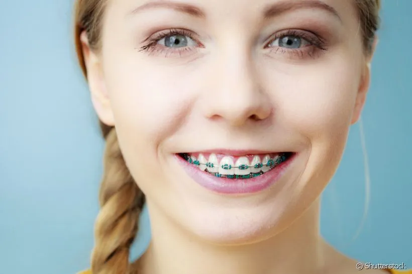 Menina loura sorrindo com aparelho ortodôntico, vista de perto.