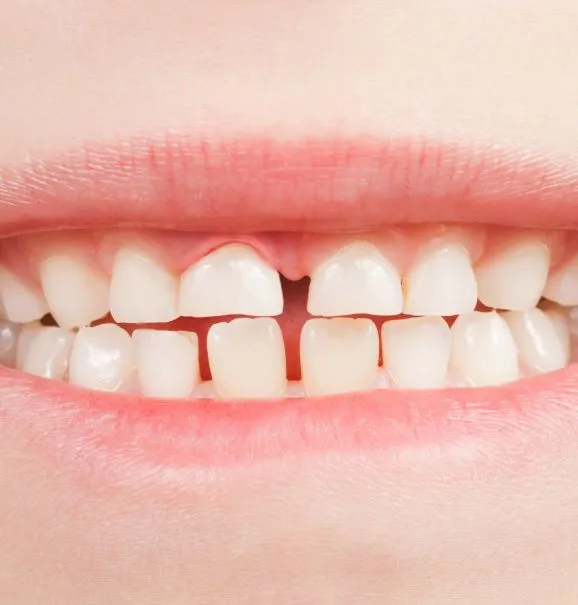 Close-up de um sorriso infantil mostrando dentes de leite e um dente permanente emergindo, ilustrando o processo natural de troca dentária na infância.