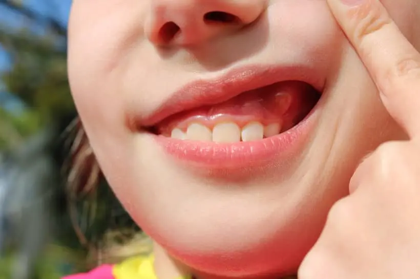 Close-up do sorriso de uma criança ao ar livre, mostrando dentes saudáveis e uma pequena bolha visível na gengiva, indicando uma possível fístula dental.