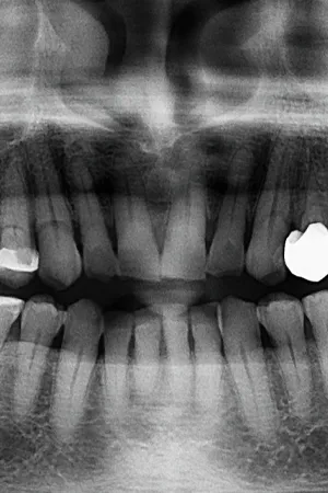 Descubra as principais soluções odontológicas para tratar a mordida aberta