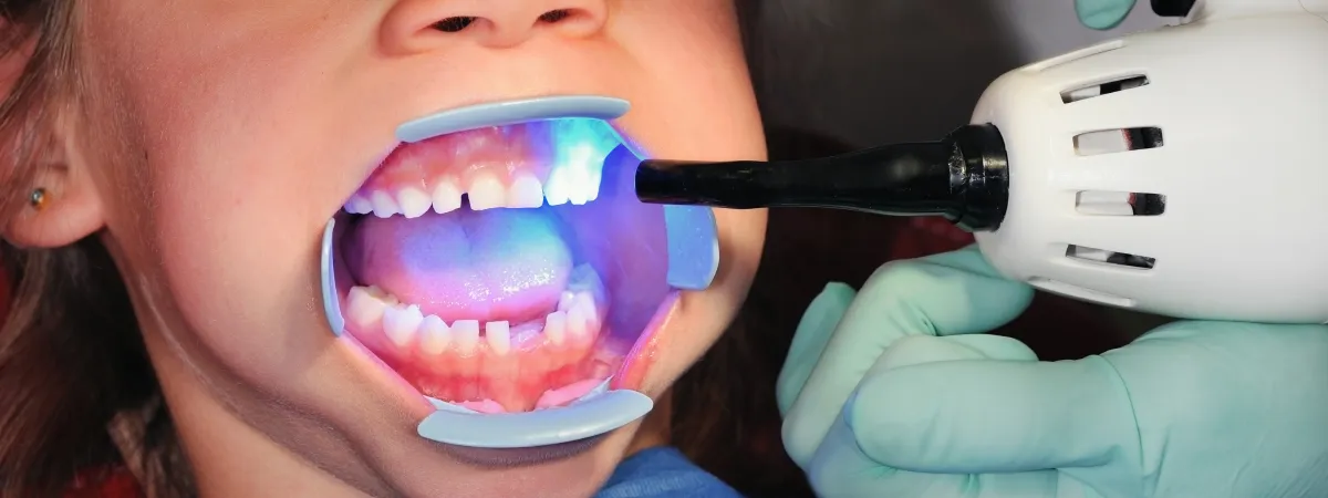 Procedimento de aplicação de selante dental em criança, mostrando luz ultravioleta sendo usada para curar o selante nos dentes