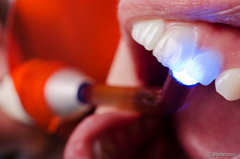 Manchas no dente causadas por um trauma ou como consequência de um tratamento de canal podem ser eliminadas com o clareamento dental interno. Conversamos com um especialista para entender como funciona e seus benefícios
