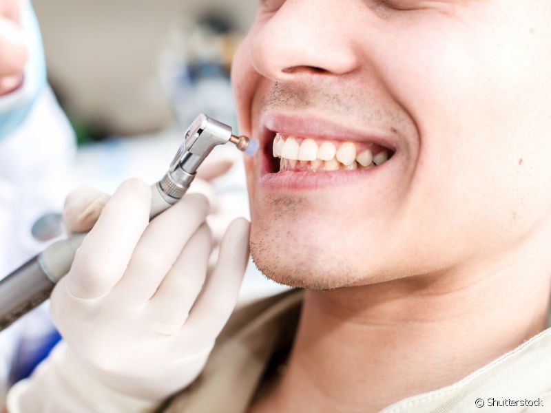 Antes do clareamento, o dentista fará uma profilaxia dentária.