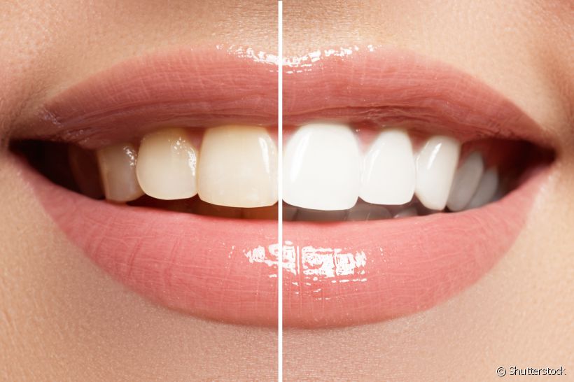 Pode não parecer, mas seus hábitos influenciam diretamente na cor dos seus dentes. Reveja-os e deixe o seu sorriso mais branco