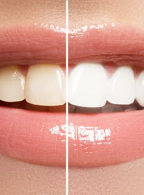 3 hábitos que podem estar deixando seus dentes amarelados