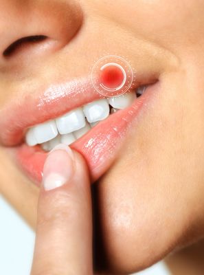 Herpes na boca é mais comum do que se imagina