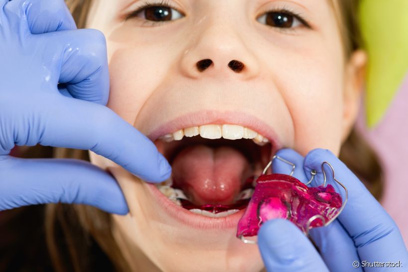 Descobriu que seu filho vai usar aparelho? A ortodontista Tatiana Rysovas explica todos os cuidados com esse acessório durante a infância