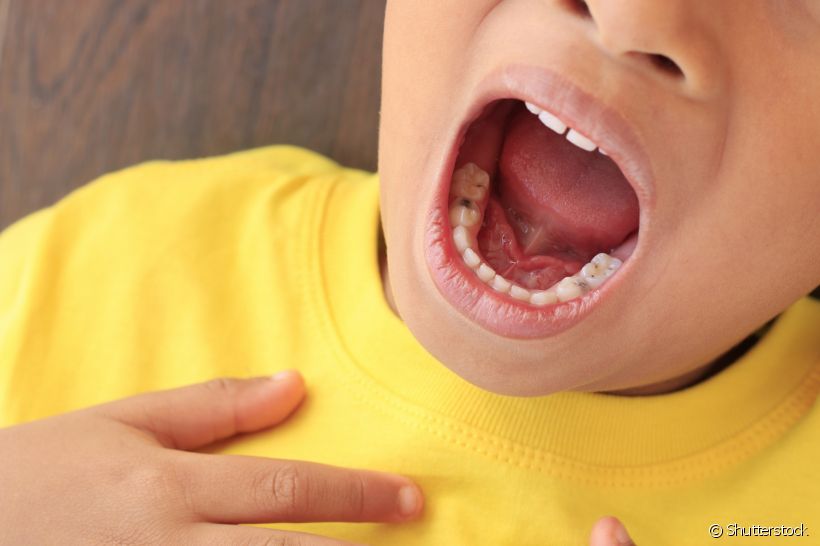 A cárie é uma doença que atinge dentes de todas as idades. Mas você sabia que existe um tipo mais grave da bactéria? A dentista Rhianna Barreto explica