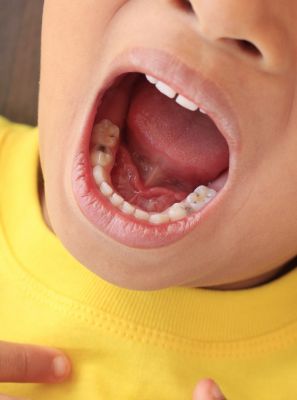 Você sabe qual é o tipo de cárie dentária mais grave?