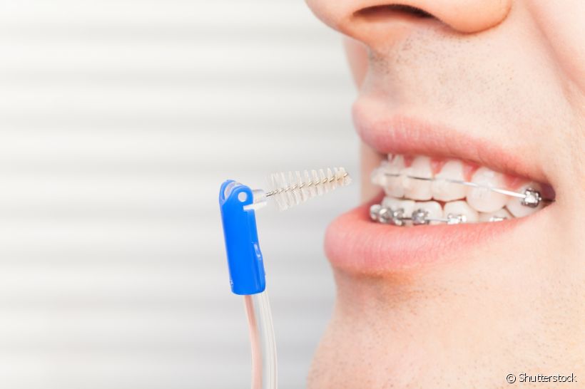 A escova interdental ainda é um objeto estranho para você? O ortodontista Marcos de Borba esclarece todas as dúvidas sobre essa ferramenta