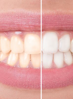 7 mitos sobre clareamento dental