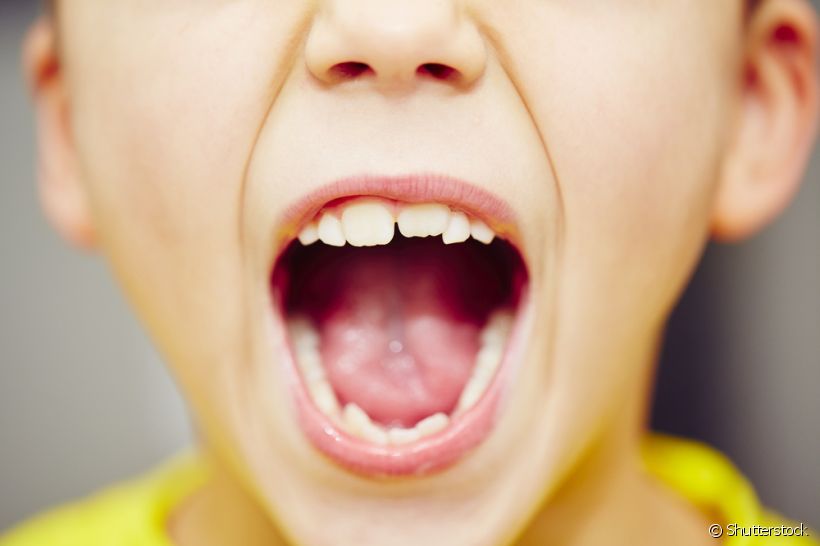 Quando o seu filho sorri, os dentes de cima não encostam nos dentes debaixo, causando uma pequena abertura chamada de mordida aberta. Saiba sobre a causa desse problema e como tratá-lo 