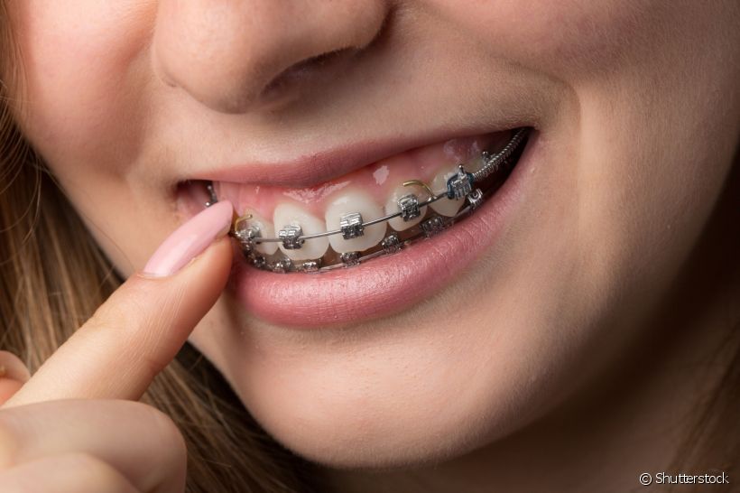 Para colocar as estruturas do aparelho ortodôntico, o dentista precisa usar uma espécie de cola para fixar os bráquetes. Será que essa substância pode fazer mal aos dentes?