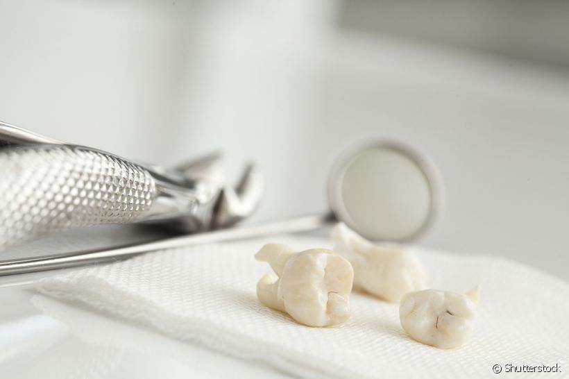 De acordo com alguns dentistas, os sisos podem ser excluídos da anatomia bucal futuramente. Será verdade?