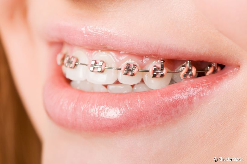 Assim que você começou o tratamento ortodôntico, sentiu seus dentes um pouco moles. Leve impressão ou isso realmente acontece? O ortodontista Marcos de Borba revela