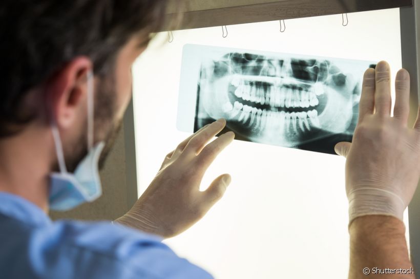 Você sabe como é feito o diagnótico da cárie? O ortodontista Robson Caumo explica se a radiografia faz parte desse processo