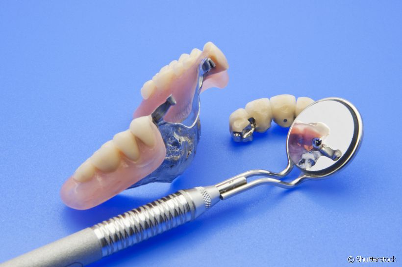 Pacientes com prótese dentária precisam ter seus hábitos modificados. Confira a lista feita pelo profissional de alguns dos principais cuidados nesses casos