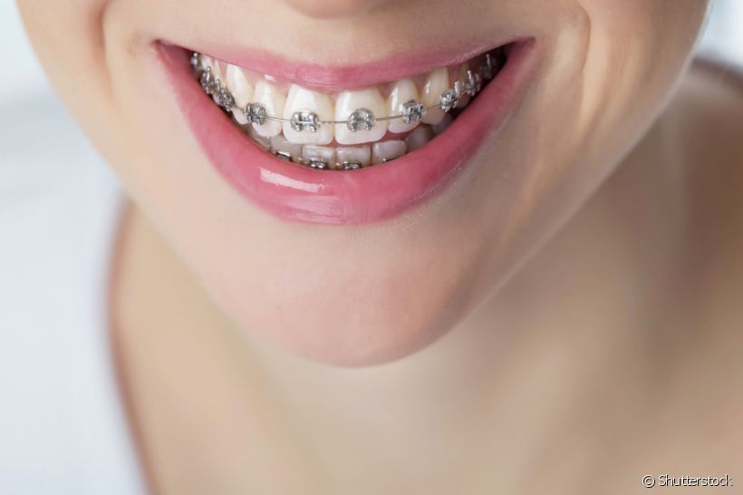Para quem usa aparelho odontológico, pode ser percebido um encurtamento da raiz do dente. Descubra se essa situação pode ser um problema com as respostas do profissional
