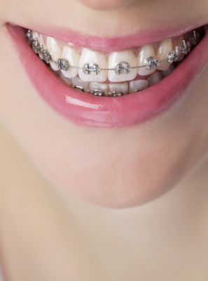 Aparelho ortodôntico encurta a raiz do dente?