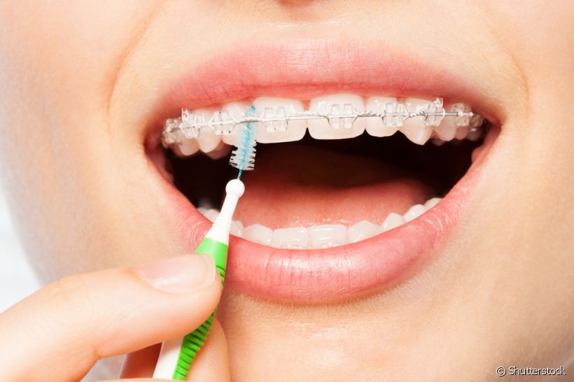 Escova Interdental Para Quem Ela é Indicada E Como Usar