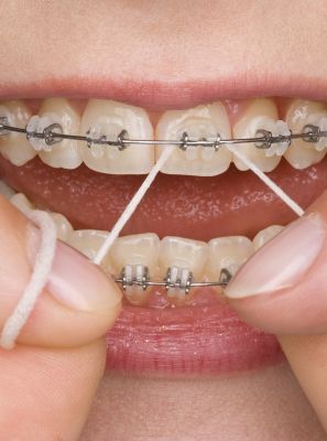 Usa aparelho ortodôntico? Veja dicas para passar o fio dental durante sua higiene