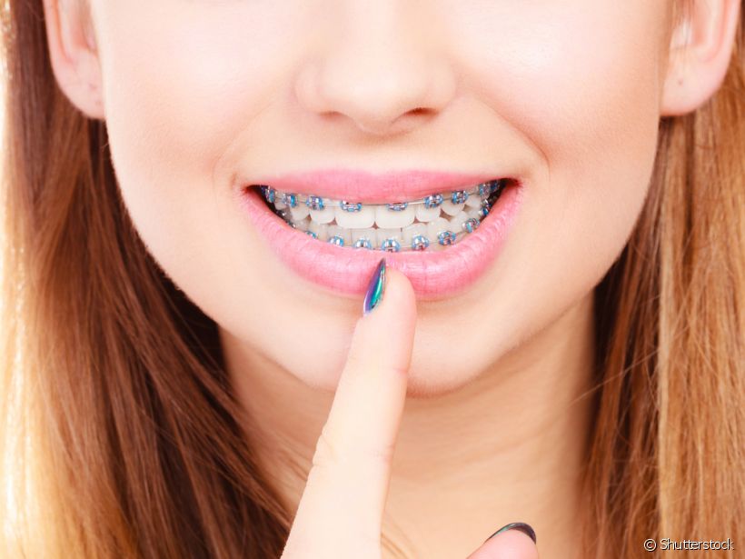 O que a Ortodontia oferece como opção para um sorriso bonito