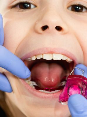 A hora de corrigir problemas de oclusão dentária é na infância.