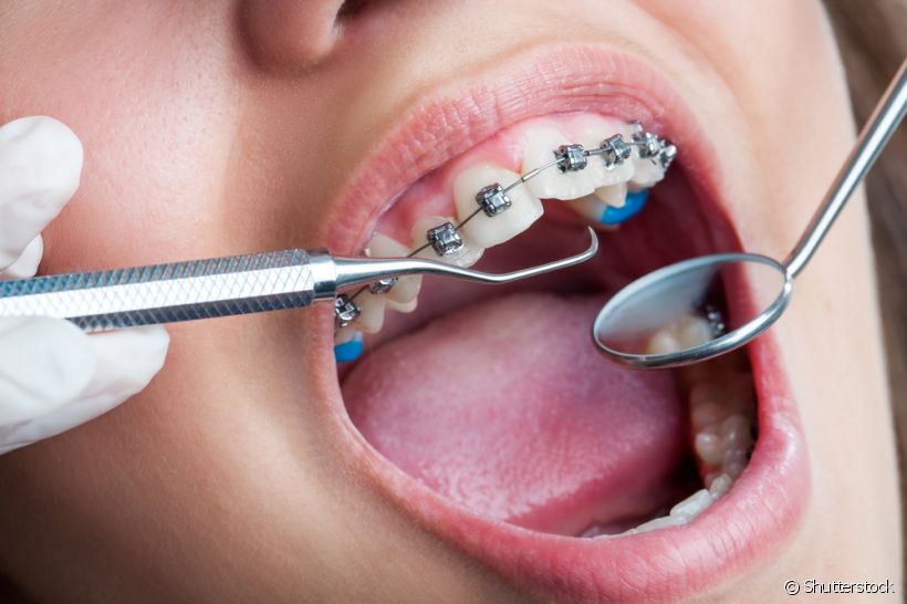 Extração do dente siso para pacientes que já estão em tratamento  ortodôntico. Veja como é feito!